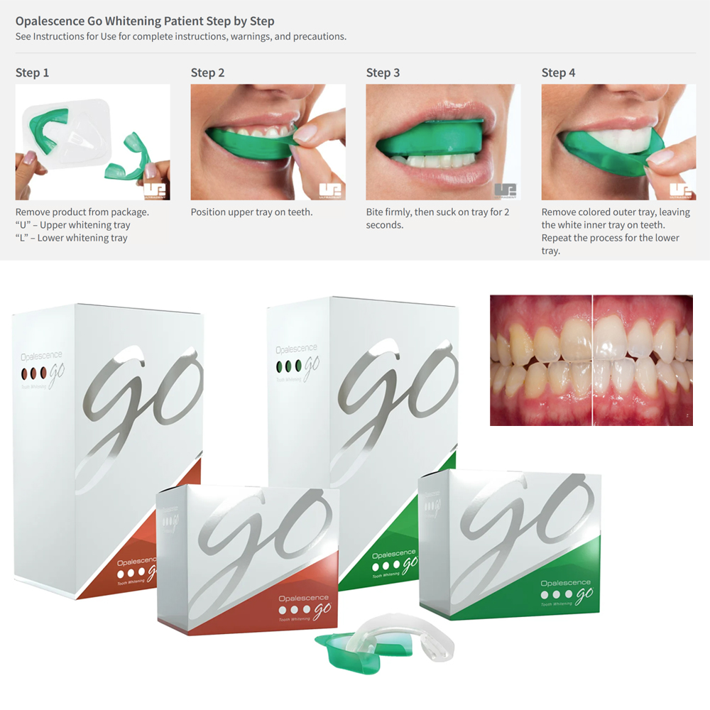 Teeth Whitening In Office - Opalescence Go Teeth Whitening Trays Prefilled