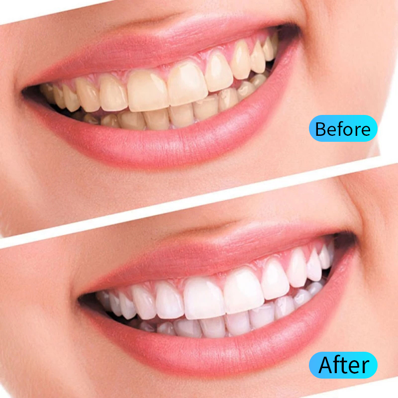 Teeth Whitening Gel Kit Oral H - Teeth Whitening Opalescence recensie en prijs
