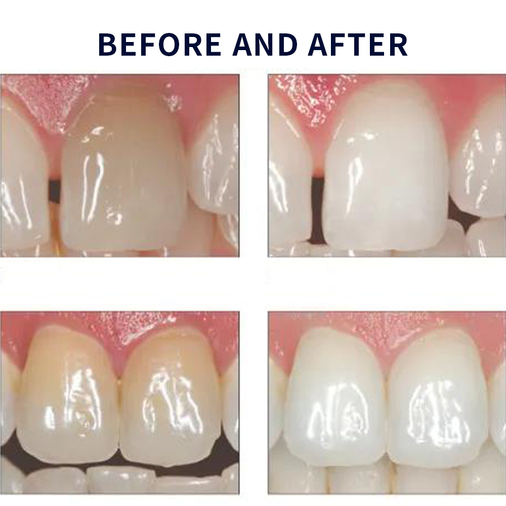 Opalescence Whitening 20% PF 2 - Teeth Whitening In Office recensie en prijs