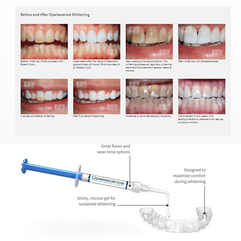Opalescence Whitening 20% PF 2 - Teeth Whitening In Office recensie en prijs