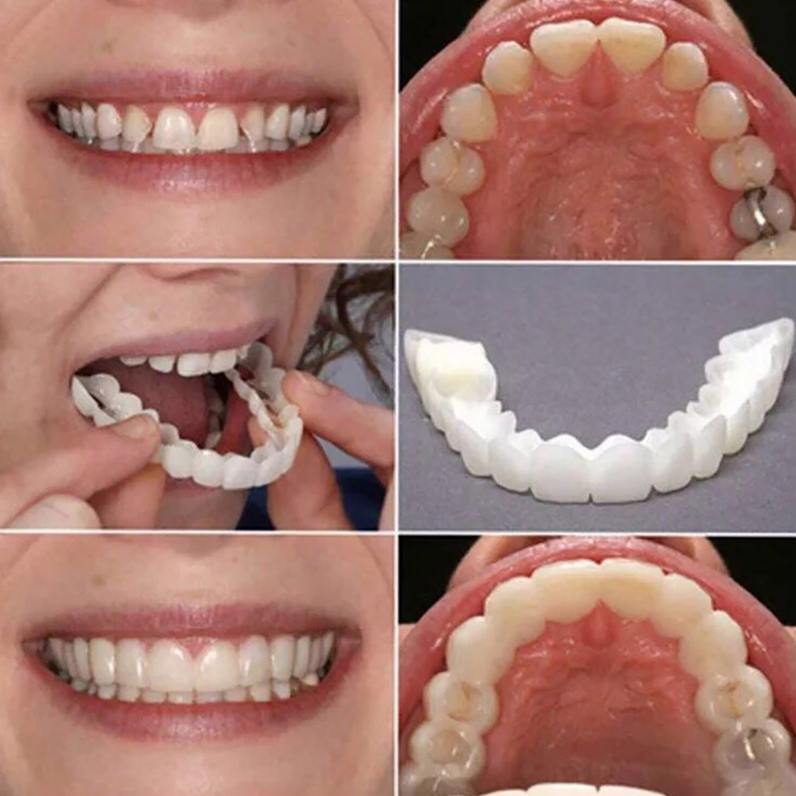Daily Commute Teeth Veneers, T - Teeth Whitening In Office recensie en prijs