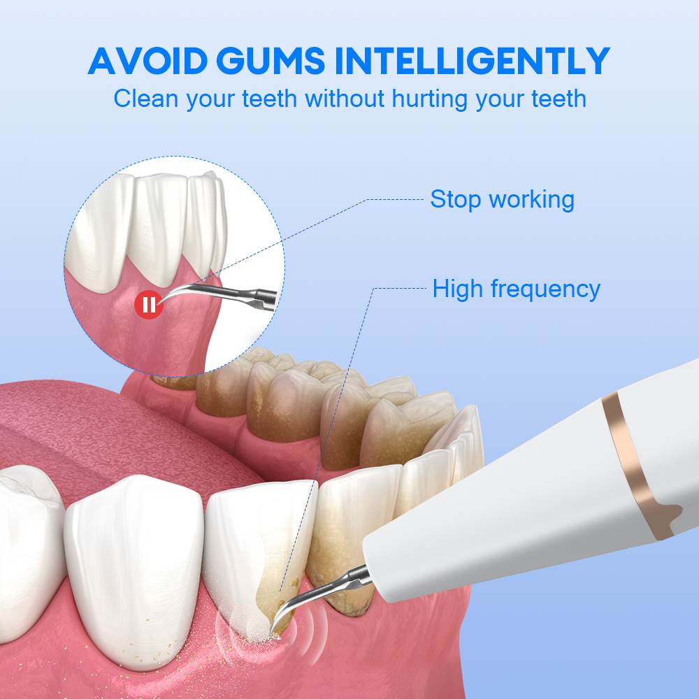 Ultrasonic Teeth Tartar Cleane - Teeth Whitening And Stain Removal recensie en prijs