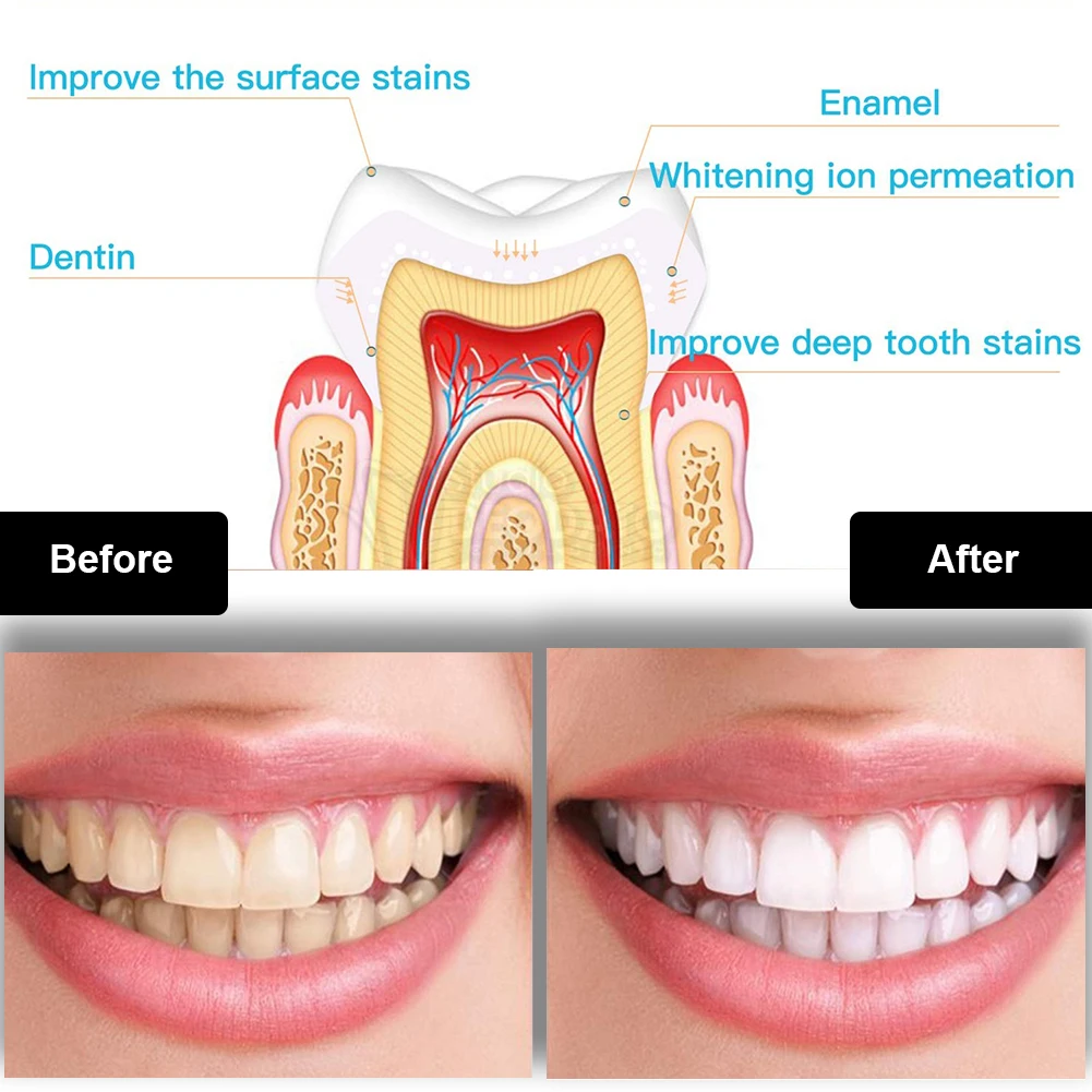 Dental Teeth Whitening Kit Min - Teeth Whitening Kit With Light recensie en prijs