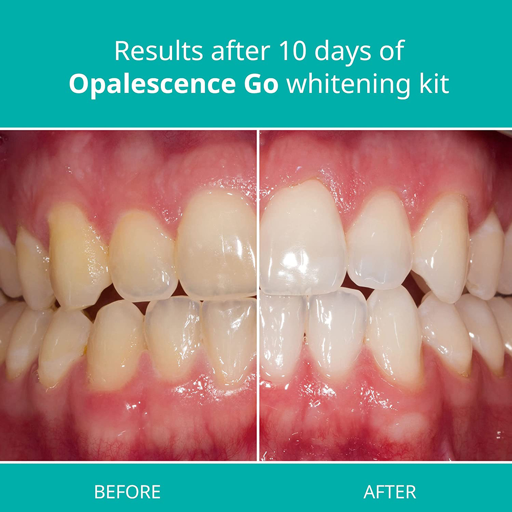 Opalescence Go Teeth Whitening - Teeth Whitening In Office recensie en prijs